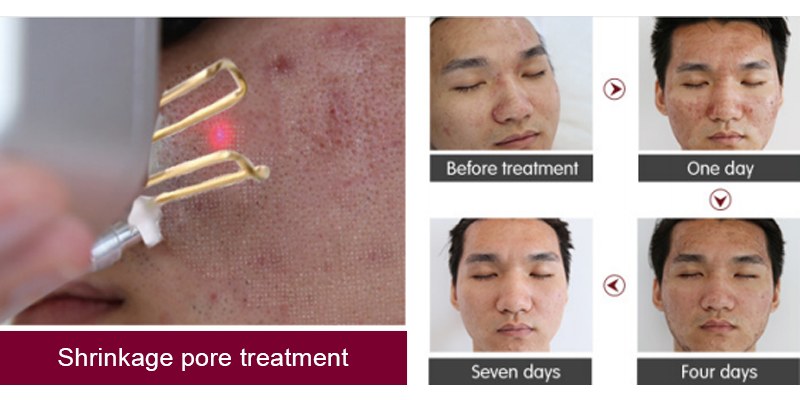 co2 facial